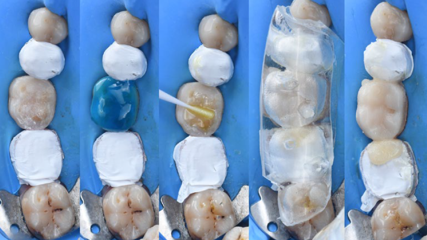 Fig. 4: Restoration of two molars: Re-establishing the occlusion with the aid of the flowable injection technique.